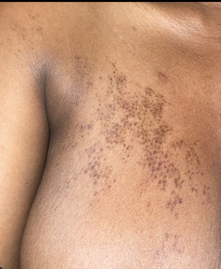 Hyperpigmentation On Back And Chest