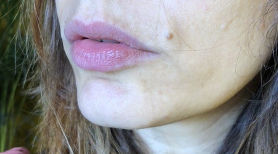 Upper Lip Lines Wrinkles Intracel Vs Ultracel And Home Microneedling Photos