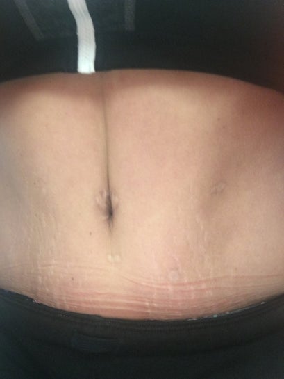 I am curious about the indentation on abdominal after tummy tuck last year.  (photos)