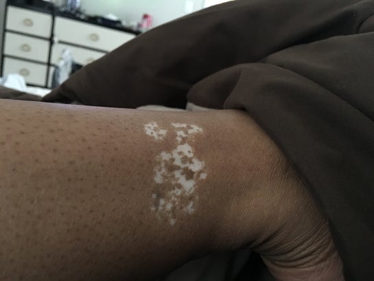 Tattoo Removal on Dark Skin  Laser Removal for Darker Skin Types  NAAMA  Studios