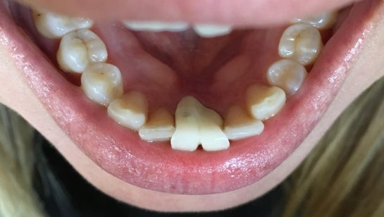Crown irritating my tongue with sharp edge. Can it be fixed? Is 