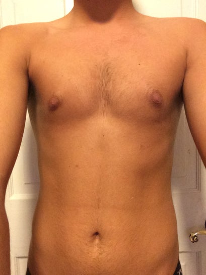 Puffy Nipples and Gynecomastia - Orange County, Newport Beach - Male Breast  Reduction