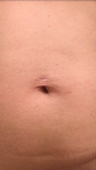 How To Heal Belly Button Piercing Hole 2025