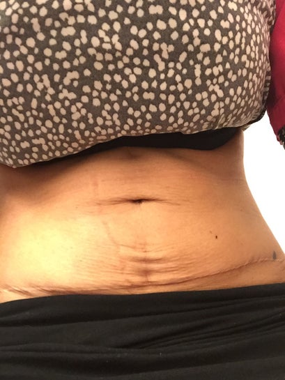 When Should You Consider Tummy Tuck Revision Surgery? Learn How to Improve  Your Results Today!, by Dr. Zoran Potparic