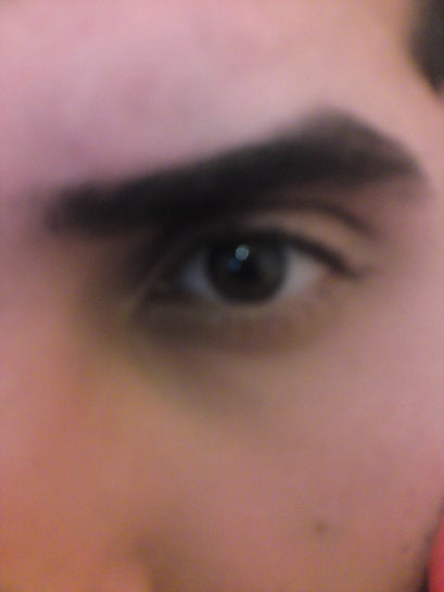 pigmentation around eyes treatment