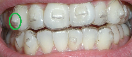 Find Out Why Some Invisalign Users Need Attachments