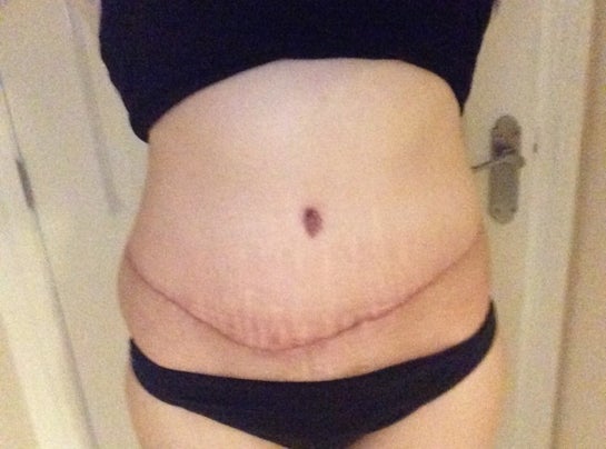 5 weeks post op, I have an asymmetric Tummy Tuck scar. Any suggestions?  (photos)