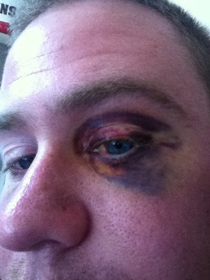 Should I Have The Surgery To Repair A Fractured Orbital Floor Photo
