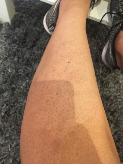 Help. My legs have all these little black dots all over them and they're  unnaturally scarred. (Photos)
