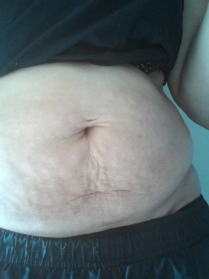 Is a yeast rash a medical reason for insurance to pay for a tummy tuck?  (photo)