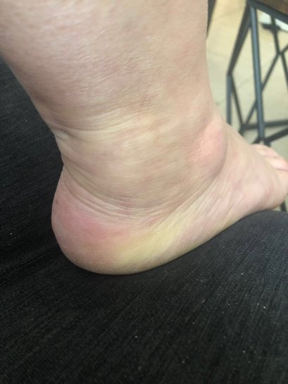 Cankles