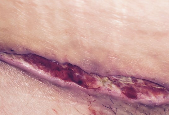 Tummy tuck complications - Infection, wound separation, seroma