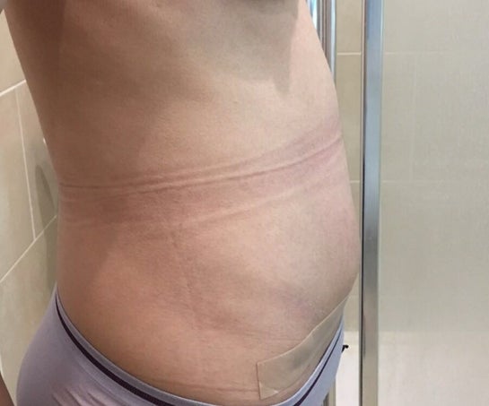 Follow Up Question Why Is My Stomach Not Flat After Full Tt With Muscle Repair