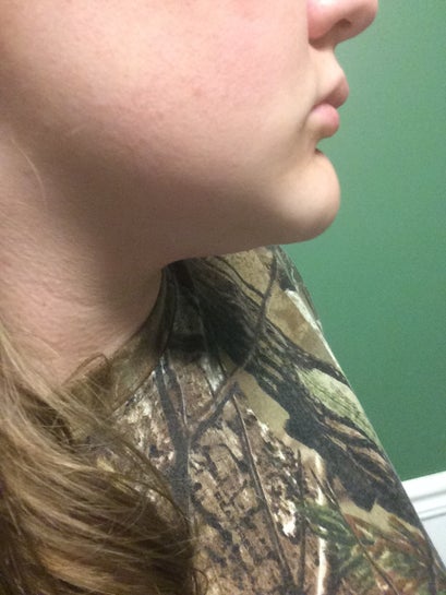 Can I Do Anything About The Extra Fat On The End Of My Chin Without Getting Surgery Photo