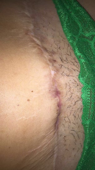 Is it normal for my pubic area below my scar to stick out more then my  belly?