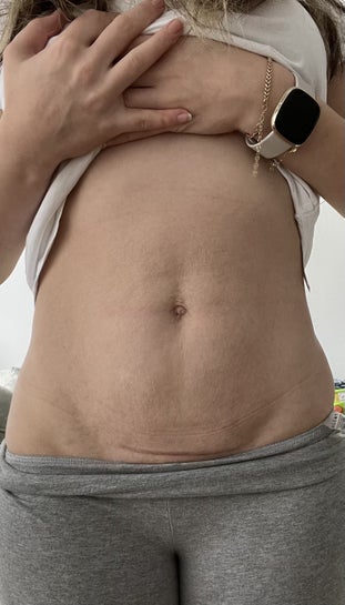Wrinkling skin around upper abdomen - am I eligible for a Mini Tummy tuck?  (photos)