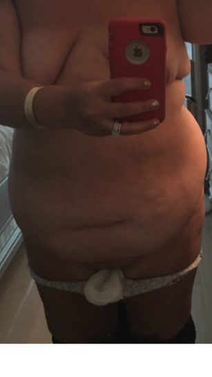 Prominent mons pubis 6-1/2 months after Abdominoplasty. It's the same as it  was at 6 weeks. Can it still be swelling? (photos)
