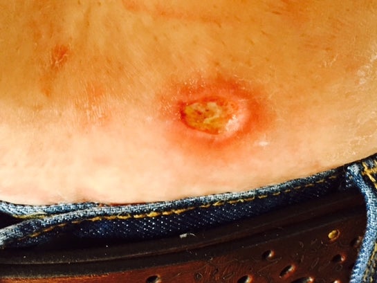 Blisters on stomach deals