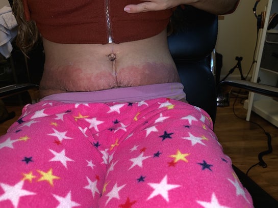 5 days PO - allergic reaction to dermabond : r/tummytucksurgery