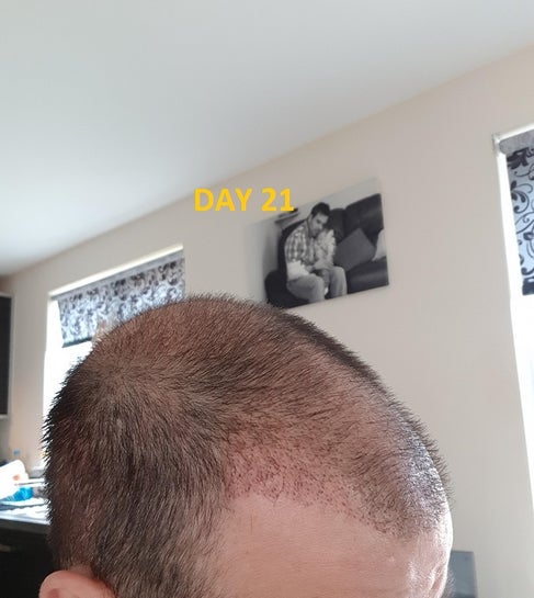 Shedding Phase Hair Transplant - Infoupdate.org