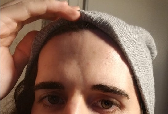 How to fix vertical line on forehead photos