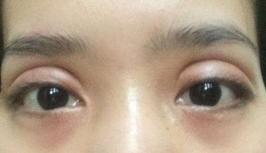 Soompi double shop eyelid surgery