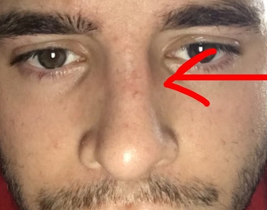 Nasal bone shifted Or swelling photos