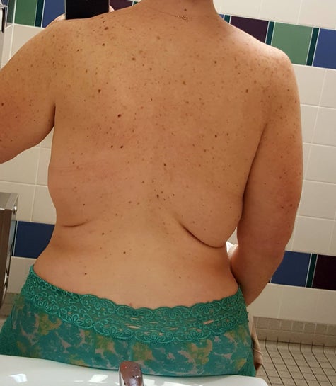 Saggy skin under breast, back boobs, and under arm skin. What can I do  about them? (photos)