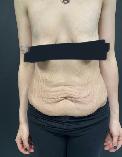 Tummy Tuck Surgery Charlotte - Abdominoplasty Charlotte North Carolina