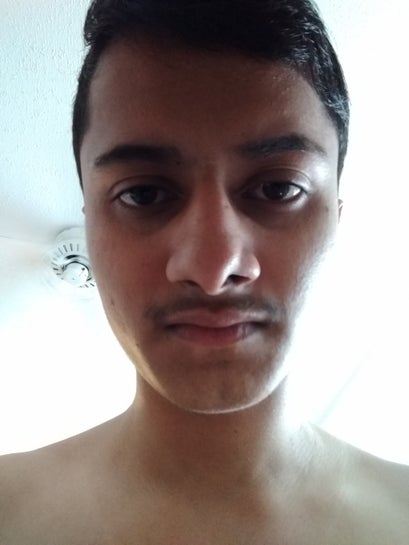 I Have No Lower Cartilage On One Side Of My Nose I Want To Know If This Could Be Permanently Fixed By Rhinoplasty Photos