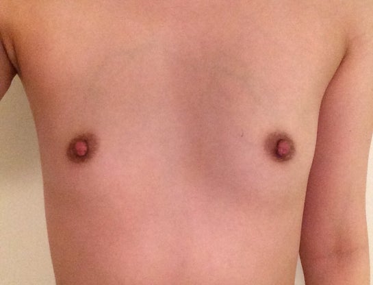 32AA breasts, what are best options for breast augmentation? (Photo)