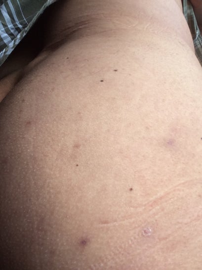 What Is A Good Treatment For Acne Scars On The Buttocks And Thighs