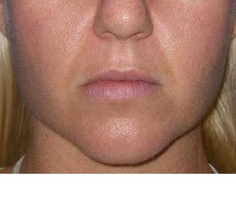 Have You Always Wanted a Chiseled Face? Learn About Buccal Fat Removal -  Ali Sajjadian, MD