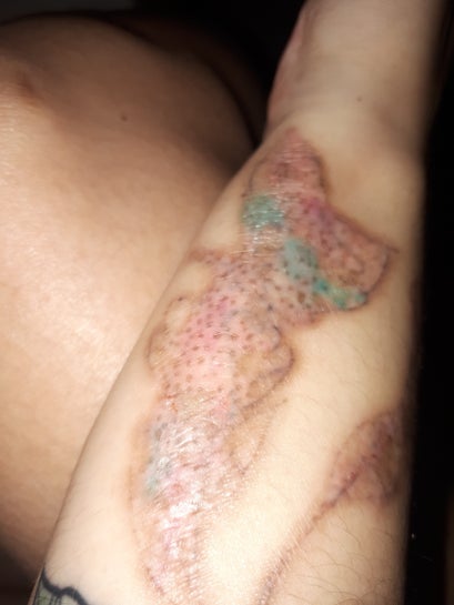 Delete Tattoo Removal  Medical Salon on Twitter Our picoway laser  safely removed tattoo on all skin tones If you are ready to get your tattoo  removed give us a call at