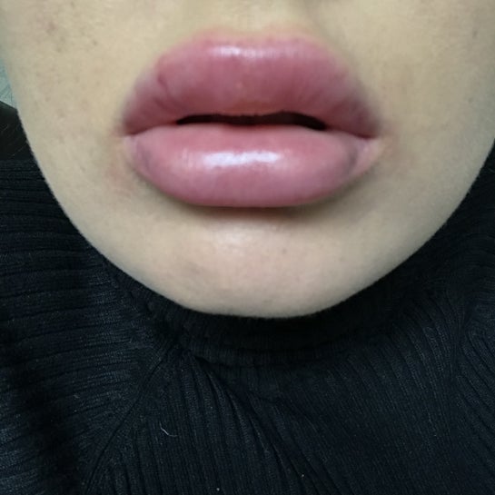 how-to-get-the-swelling-down-after-lip-fillers-sitelip