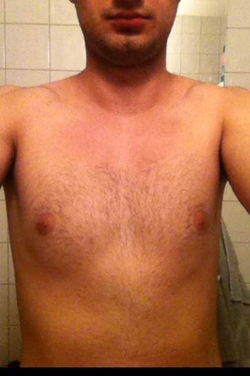 Breast Augmentation for Asymmetrical Breasts - Ali Sajjadian, MD