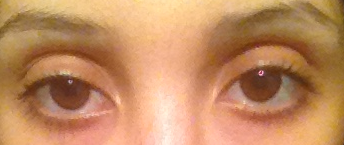 prominent eyelids