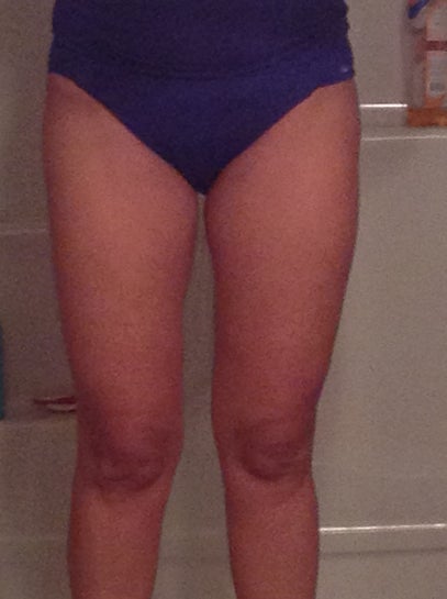 Uneven inner thighs after liposuction. What can be done to even them out?  (Photo)