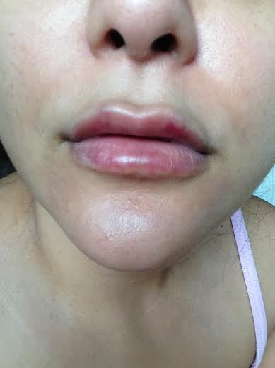 Lip Filler Swelling Stages: What Is Normal