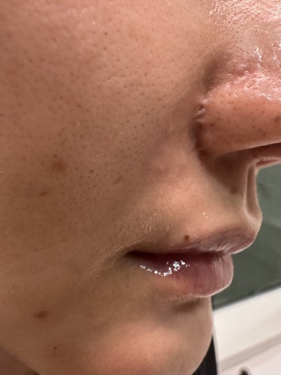 Scar revision post surgery - what would be the best options? (Photo)