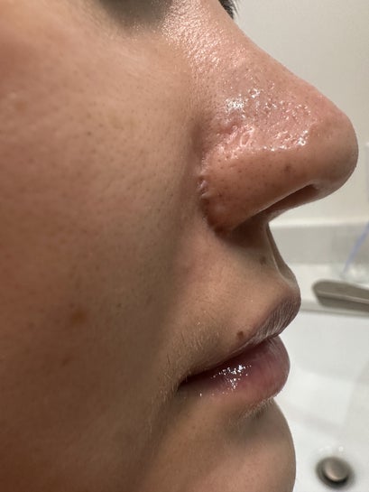 Scar revision post surgery - what would be the best options? (Photo)