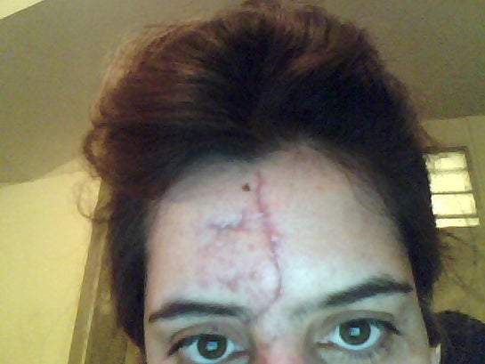 contractubex gel for dark spots