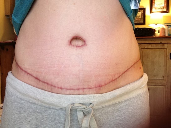 Mum-of-three's tummy tuck scar explodes after botched surgery following  three caesarean sections - Mirror Online