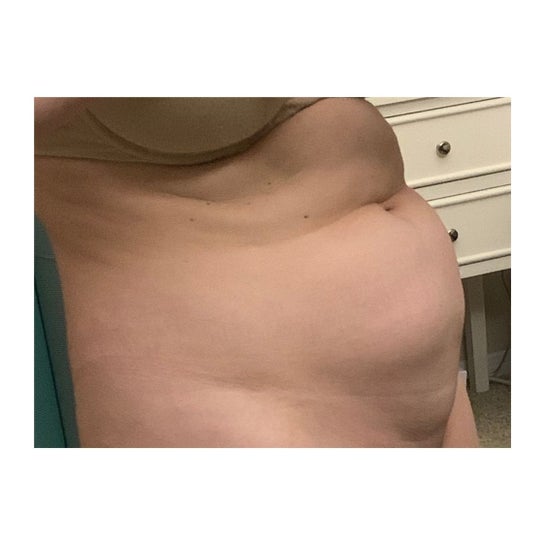 Are there any alternatives for the faja or lipo foam/faja combination?  (photos)