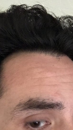 FUE - 1000 grafts - Reconstruction of hereditary hair loss
