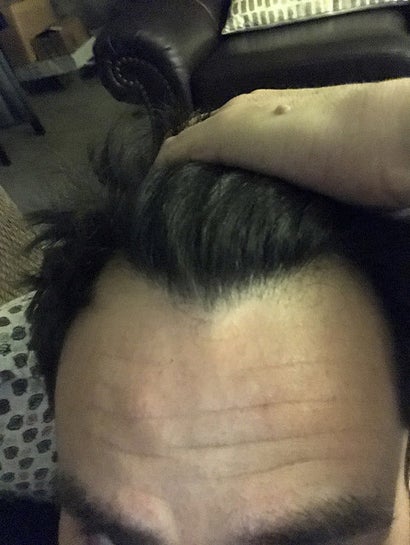 Am I A good candidate for 500 graft FUE transplant for my hairline. (photos)