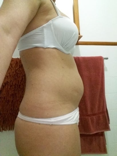 Weight Loss Before Or After Liposuction