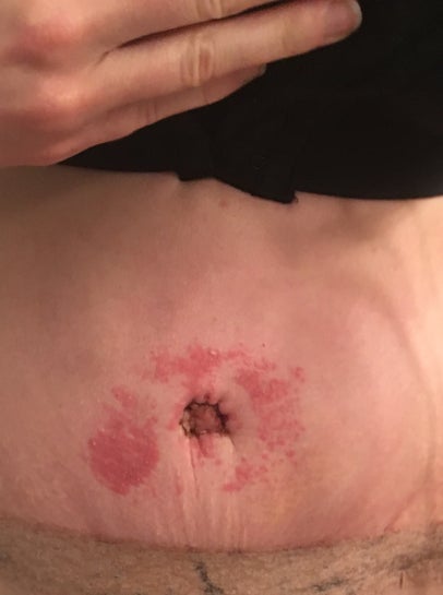 What should I do about this rash around my belly button after
