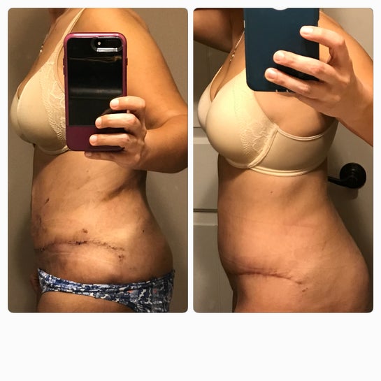 5 days post OP tummy tuck, issues with abdominal binder : r