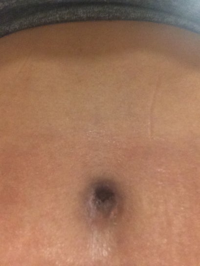 waist trainer after tummy tuck